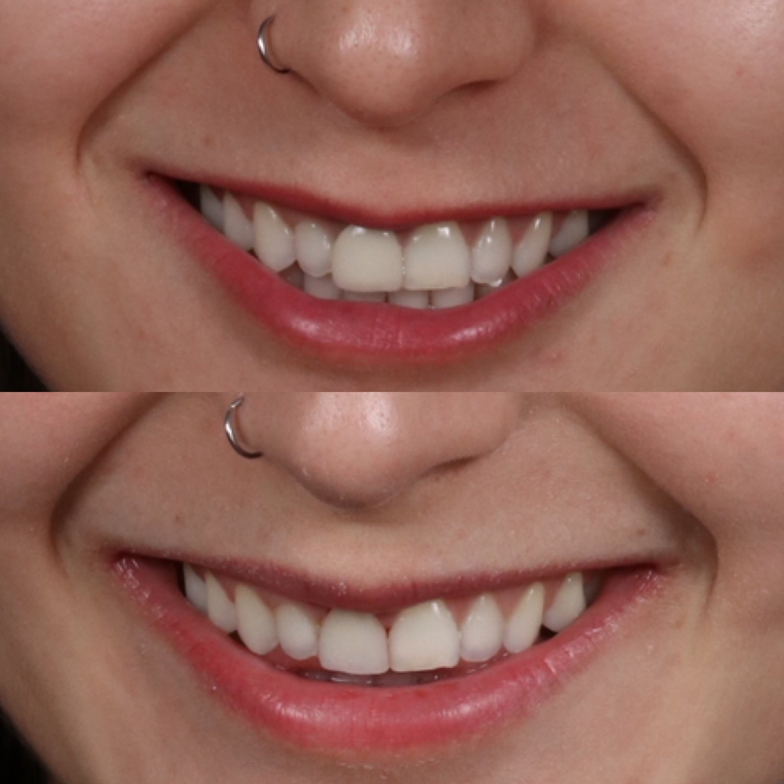 Carillas dentales - Caso 5